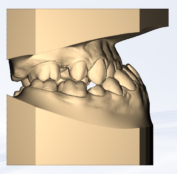 prognath adj Dental 3D print model - Mito3D
