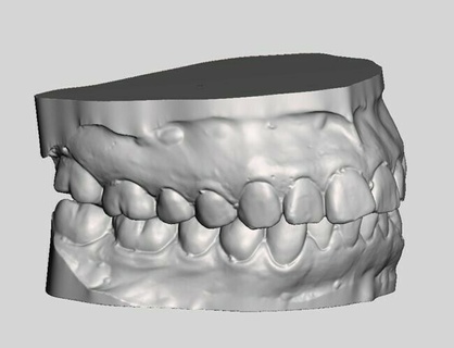 ready to print diş uygulama modeller model ağda Hazırlıklar 3d print model - Mito3D