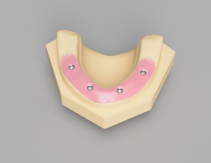 Referenz Meister Besetzung implantieren Analoga Dental Zahnarzt Niveau Bild Scan Widerlager dr Zahn Schraube beibehalten Halter 3d print model - Mito3D