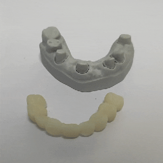 removable tooth bridges temporary dental models resin prosthetic dentistry education research development prosthodontist 3d print model - Mito3D