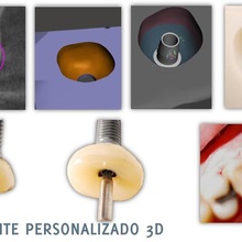 scar cap base generating emergency profile various emergence dental dentistry odontologist 3d print model - Mito3D
