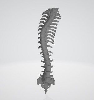 scoliosi colonna vertebrale 1 vari traumatologia ortopedia toracolombare lombare toracica modello tomografia tac ct 3d print model - Mito3D