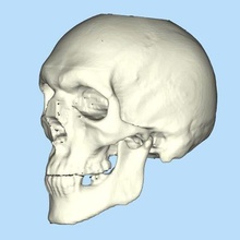 skull  skull cranial flap cmf cranioplasty