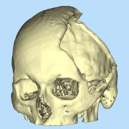 skull cranial flap  skull