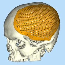 skull cranial flap 1 cmf cranioplasty 3d print model - Mito3D