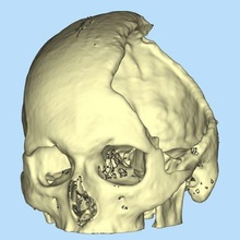 skull cranial flap  skull cranial flap cmf cranioplasty