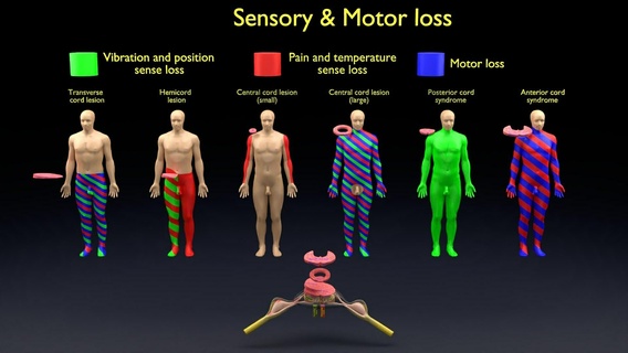 spinal cord injuries various sensory motor loss muscle touch vibration pain position temperature injury lesions paralysis spinal-cord paraplegia hemiplegia 3d print model - Mito3D