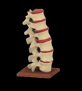 colonna vertebrale difetti umano cervicale lombare spinale disco pieno diverso parti medico anatomia ossatura cavo ernia rigonfiamento modello 3d print model - Mito3D