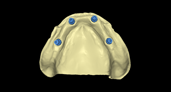 stl modelo implantes 4 estude dental Barra odontologia 3d impressão Arquivo digital arte inovação 3d print model - Mito3D