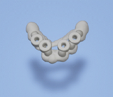 chirurgical guider dentaire implant 2 dent dents dentier technicien stomatologie pont 3d print model - Mito3D