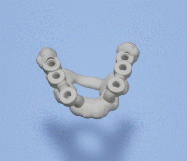 chirurgisch leiten Dental implantieren 3 Zahn Zähne Prothese Techniker Stomatologie Brücke 3d print model - Mito3D