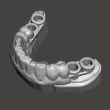 quirúrgico entablillar guiado cirugía Arte dental odontología implantologia 3d print model - Mito3D
