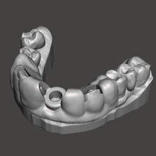 cirúrgico tala guiado cirurgia arte dental odontologia implantologia 3d print model - Mito3D