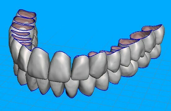 teeth temporary crowns - maxillary+mandibular-teeth 3D print model - Mito3D