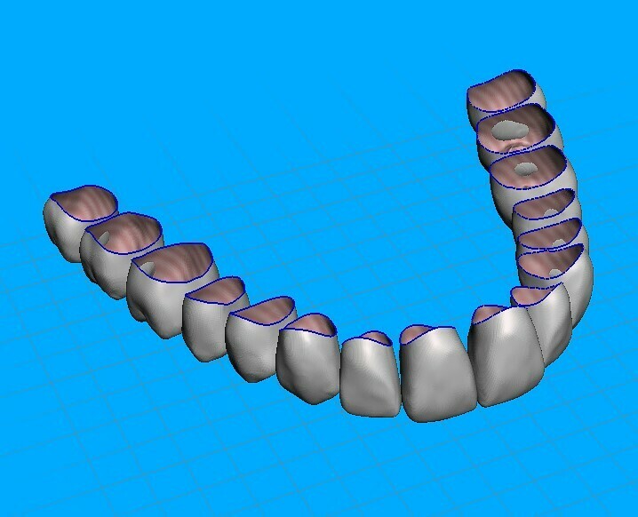 teeth temporary crowns - maxillary-teeth 3D print model - Mito3D