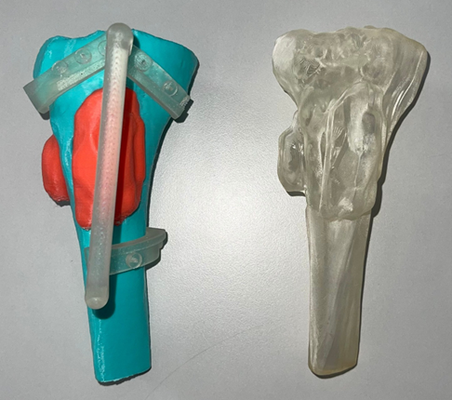 tibial ostéosarcome tibia sarcome tumeur cancer condyle cartilage chirurgical guider anatomie 3d print model - Mito3D
