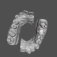 formación dientes dental estudiantes negro caries clasificación diente clase 3d print model - Mito3D