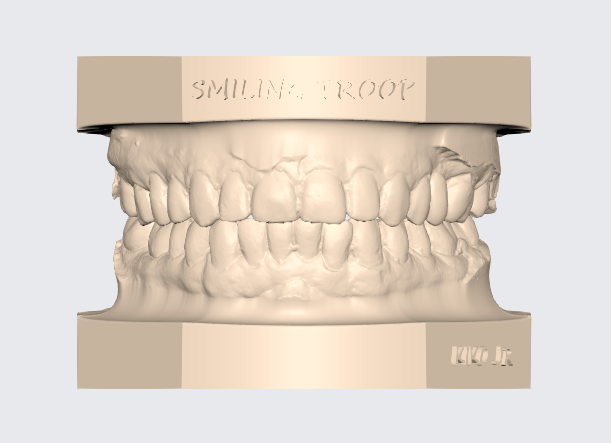 upper articulated dental model 6 prosthetist technician tooth 3d stl dentist free orthodontics print 3D print model - Mito3D