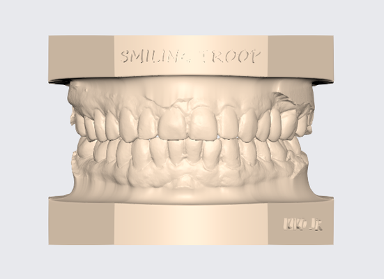 superiore articolato dentale modello 6 protesista tecnico dente 3d stl dentista gratuito ortodonzia stampa 3d print model - Mito3D