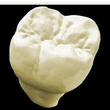 molar superior dental dentes técnico odontologia 3d print model - Mito3D