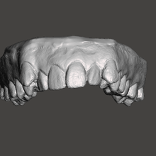 os dentes de cima digitalização disalignment art dental 3dscan 3d print model - Mito3D