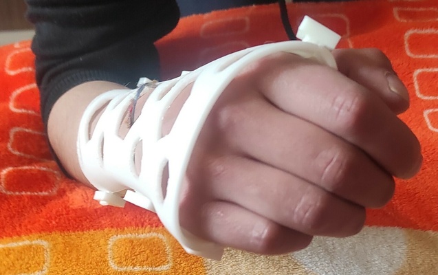 bilek kolun ön kısmı atel oyuncak bebek rehabilitasyon tıbbi cihaz prototip kemikler kemik kırık travmatoloji esnek renkli ender 3d print model - Mito3D