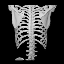 spine t10 chance fracture education bone skeleton 3d print model - Mito3D