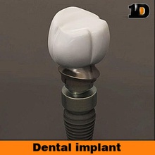 implante dental 3d 3ds la anatomía cuerpo carácter de dentadura humanos implontant max médica modelo oodindd prótesis realista ciencia dientes 3d print model - Mito3D