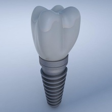 diş implantı anatomi vücut karakter dent hekimi hekimliği protez ekipman insan implant implantasyon tıbbi tıp model azı dişleri ortodontist kontrolü bilim bölüm 3d print model - Mito3D