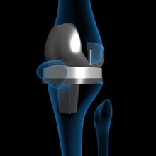 Knie-Ersatz 3d Anatomie animation künstlicher Körper Charakter Mensch Implantat Gelenk Knie die medizinische Modell prothetische - Ersatz Wissenschaft Chirurgie zhenya85 3d print model - Mito3D