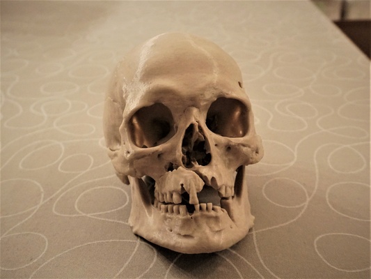 human skull battle injuries 3d scan historiska museet 260727 remixed by suit1337 education models axe viking death history danish humanskull skulls peasant dane danes battledamage gutnic 3d print model - Mito3D