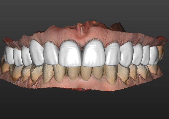 paciente 001 superior restauracion forma alfiler dental 3d print model - Mito3D