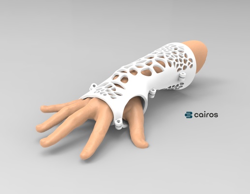braço tala fundida gesso médico alfinete arm splint 3d print model - Mito3D