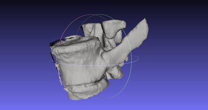 vertebra mr pinshape mrı tıbbi biyomedikal 3d print model - Mito3D