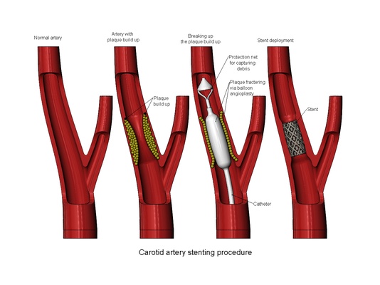 3d imprimible carótida artería colocación stent procedimiento diorama forma alfiler 3d print model - Mito3D