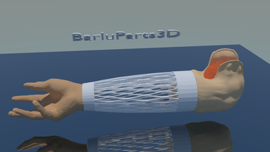prothèse bras voronistyle pinshape l'intérieur portée conception 3d challenge 18 ans soutien prothétique 3d print model - Mito3D