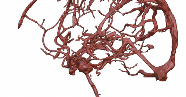 cerveau artères anévrisme ppcab 3D modèles apprentissage chimie biologie sang accident vasculaire cérébral 3d print model - Mito3D