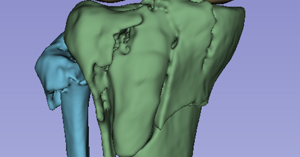 tibia fibule fracture Austin Quinn Télécharger libre stl modèle imprimablescom 3d modèles monde scans anatomie ct fémur genou 3d print model - Mito3D