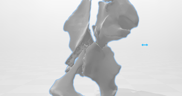 pelvien fracture Austin Quinn Télécharger libre stl modèle imprimablescom 3d modèles monde scans anatomie cassé hanche segmentation 3d print model - Mito3D