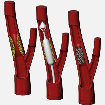 carótida artéria stent procedimento diorama impressão pronto 3d modelo raquidsw 3D print model - Mito3D