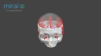 cerebro tumor cráneo sangre vasos 3d modelo mirai3d 9be1700 3d print model - Mito3D