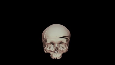 cranio tumore vcu 3d 5375 modello virtuale cura laboratorio virtualcurationlab be2af6b 3d print model - Mito3D
