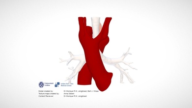 aortico arco inviare operazione Scarica gratuito 3d modello medico arte come 40eb6a5 3d print model - Mito3D