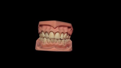 jaw-scan-upper-and-lower - download free 3d model thunk3d lilyqin1 3dfa2ab 3d print model - Mito3D