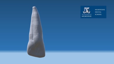 maxillary l permanent lateral incisor fdi 21 - 3d model melbourne dental school ritasodontology 3782f1b 3d print model - Mito3D