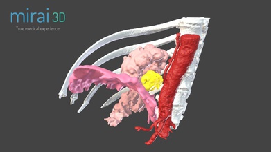 medical model wp1 - 3d mirai3d 0c937a0 bochdalek diaphragmatic herina 3d print model - Mito3D
