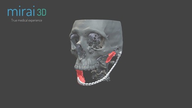 modelo médico wp4 - 3d mirai3d 686a59e placa de titanio mal funcionamiento después maxilofacial resección tumor la reconstrucción 3d print model - Mito3D