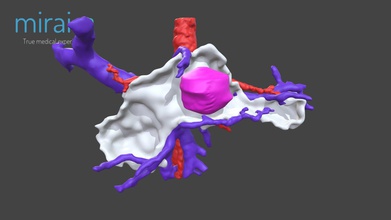 o modelo médico wp5 - 3d mirai3d 02e418a pediátrica tumor pancreático 3d print model - Mito3D