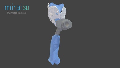 modello medico wp6 - 3d mirai3d 387ce68 laringo-tracheale in plastica di ricostruzione dopo l'incidente auto 3d print model - Mito3D