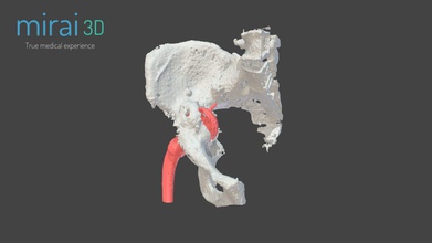 medical model wp7 - 3d mirai3d 94a055a acetabulum fracture hip replacement 3d print model - Mito3D